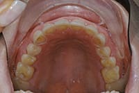 Effects of bulimia on the teeth | dentist in dallas