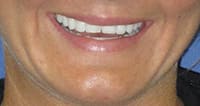 A close-up of the patient’s smile | dental office in Dallas, Texas