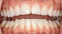 fragile edges of the upper front teeth | Dallas Dentist