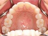 The palatal view shows erosive wear on the lingual, or inner, surfaces of the front teeth