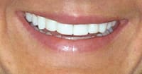 SEZI (SmilePix) image | best dentist in dallas