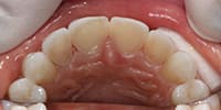 Final preparation of teeth | Dallas Dental Wellness