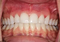 A retracted (after) photo showing lingual veneers in place | Dallas Dentist