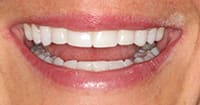 The patient’s full smile | Dentist in Dallas, TX