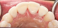 Palatal view immediately after veneers were placed | best dentist in dallas