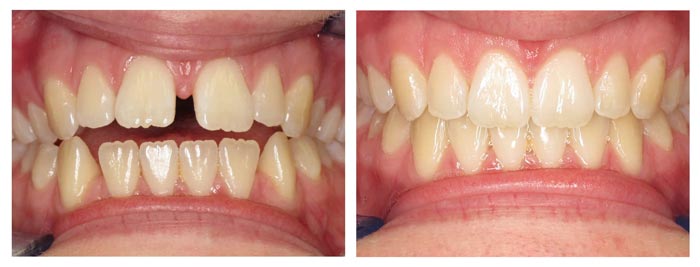 Before and After Invisalign Treatment