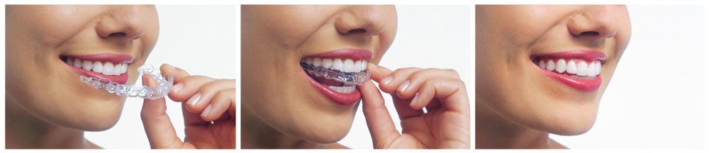 Wearing Invisalign