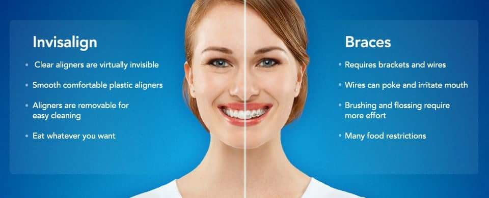 Invisalign vs. regular braces
