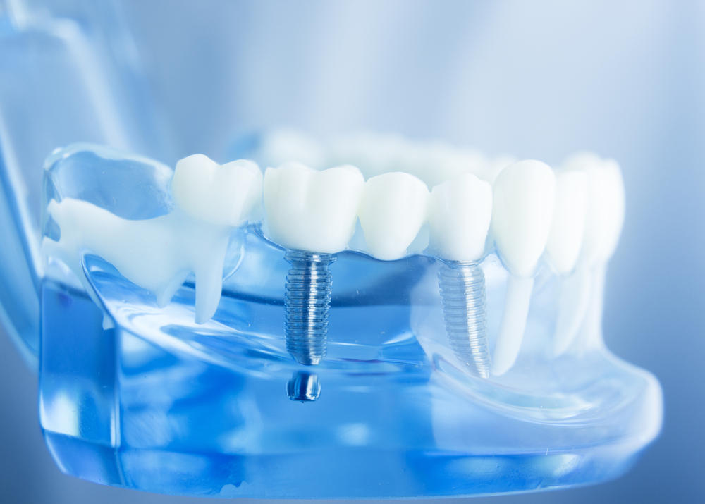 What You Need to Know about Dental Implants | Dallas Dental Implants