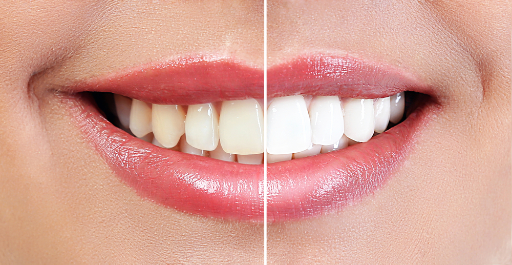 Cosmetic Dentistry by Dallas Dental Wellness | Before and After
