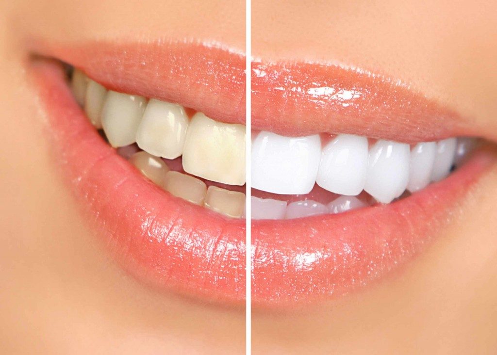 Dallas Teeth Whitening | What You Need To Know