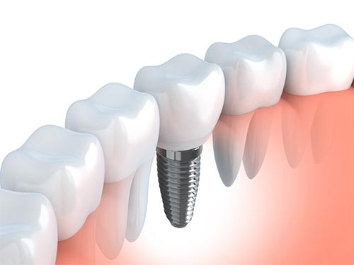 Dental Implants Can Restore Your Smile | Dallas Cosmetic Dentist | Dallas Dentral Wellness