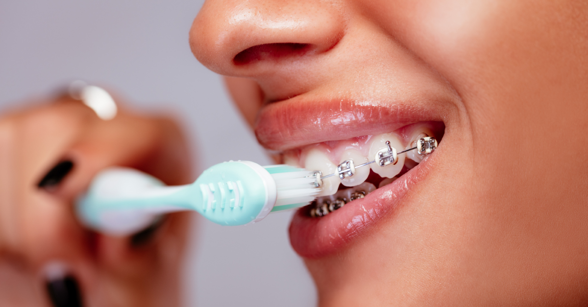 How to Brush Your Teeth with Braces Dallas Dentist Dr. Sarah Kong