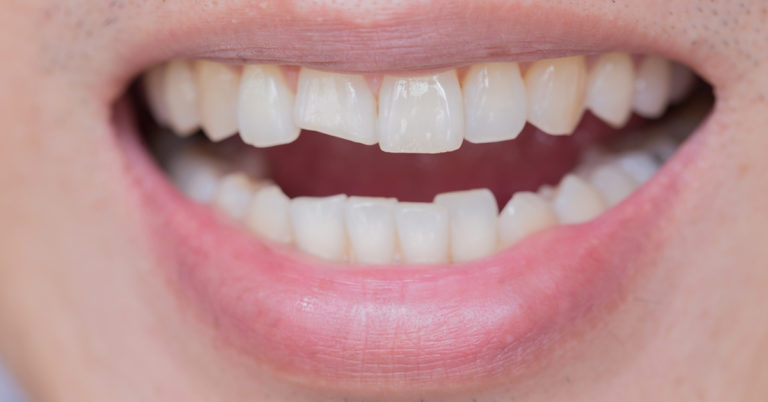 What Happens If I Leave A Cracked Or Broken Tooth Untreated 