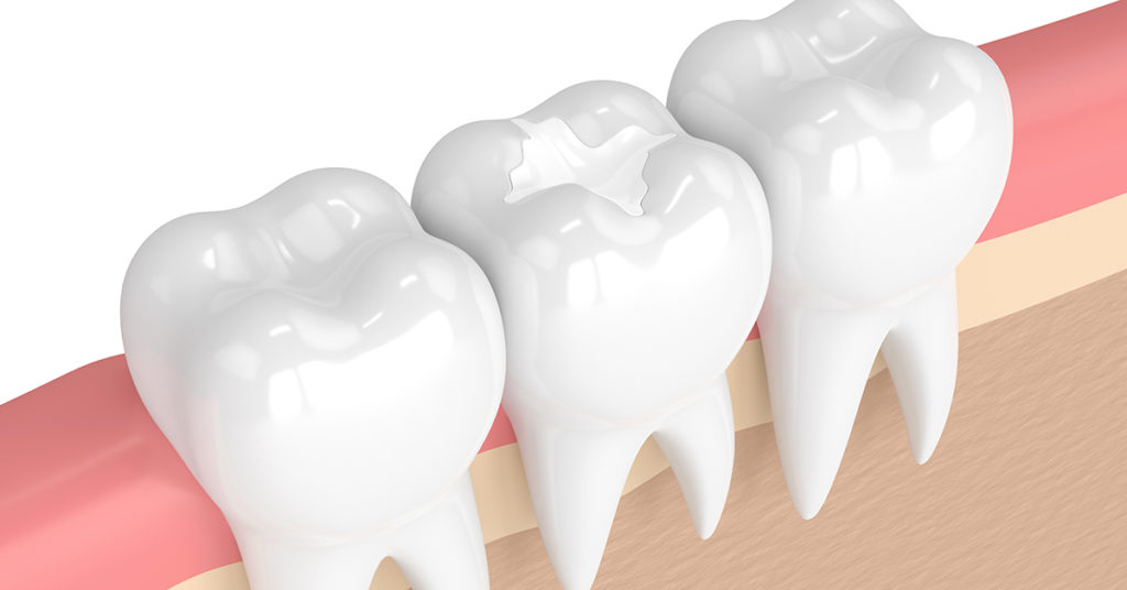 The Benefits of Dental Sealants